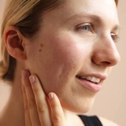 3-step Starter Set: Acne Prone Skin -Yogaye Ventas 5 acne starter kit PDP